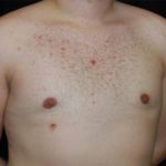 Gynecomastia Before & After Patient #23321