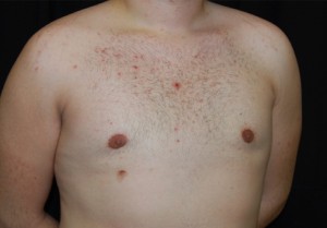 Gynecomastia Before & After Patient #23321