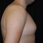 Gynecomastia Before & After Patient #23321