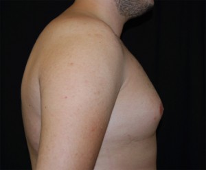 Gynecomastia Before & After Patient #23321