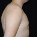 Gynecomastia Before & After Patient #23321