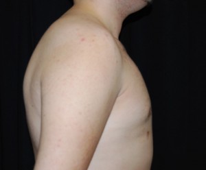 Gynecomastia Before & After Patient #23321