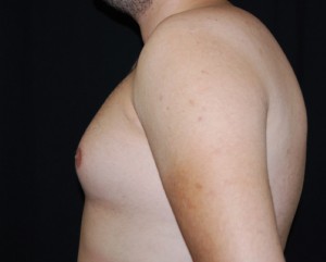 Gynecomastia Before & After Patient #23321