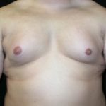 Gynecomastia Before & After Patient #21221