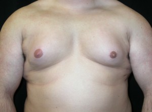 Gynecomastia Before & After Patient #21221