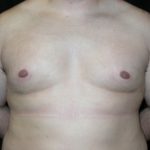 Gynecomastia Before & After Patient #21221