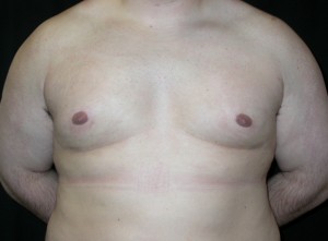 Gynecomastia Before & After Patient #21221