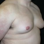 Gynecomastia Before & After Patient #21221