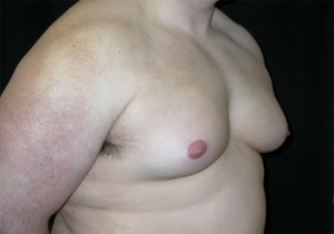 Gynecomastia Before & After Patient #21221