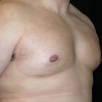 Gynecomastia Before & After Patient #21221