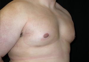 Gynecomastia Before & After Patient #21221