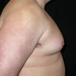 Gynecomastia Before & After Patient #21221