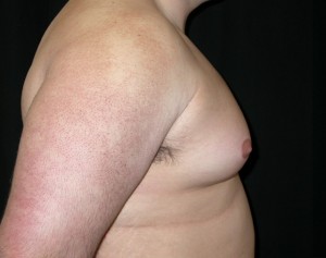 Gynecomastia Before & After Patient #21221