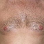 Gynecomastia Before & After Patient #21284