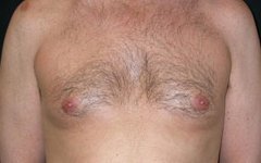 Gynecomastia Before & After Patient #21284