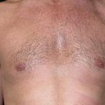 Gynecomastia Before & After Patient #21284