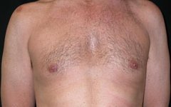 Gynecomastia Before & After Patient #21284