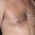 Gynecomastia Before & After Patient #21284