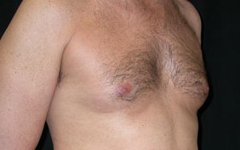 Gynecomastia Before & After Patient #21284