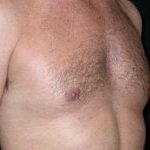 Gynecomastia Before & After Patient #21284