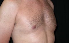 Gynecomastia Before & After Patient #21284