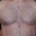 Gynecomastia Before & After Patient #21262