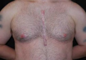 Gynecomastia Before & After Patient #21262