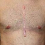 Gynecomastia Before & After Patient #21262