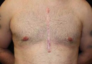 Gynecomastia Before & After Patient #21262