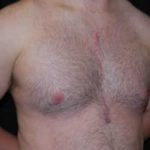 Gynecomastia Before & After Patient #21262