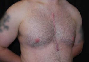 Gynecomastia Before & After Patient #21262