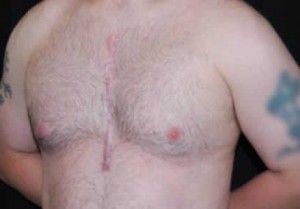 Gynecomastia Before & After Patient #21262