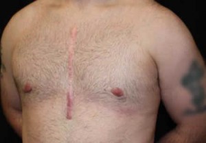 Gynecomastia Before & After Patient #21262