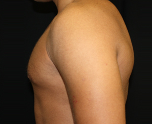 Gynecomastia Before & After Patient #21240