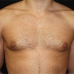 Gynecomastia Before & After Patient #21240