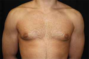 Gynecomastia Before & After Patient #21240