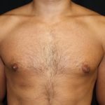 Gynecomastia Before & After Patient #21240