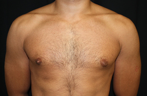 Gynecomastia Before & After Patient #21240