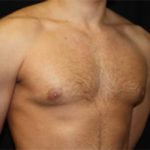 Gynecomastia Before & After Patient #21240