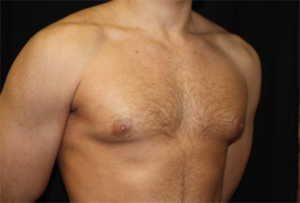 Gynecomastia Before & After Patient #21240