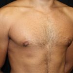 Gynecomastia Before & After Patient #21240