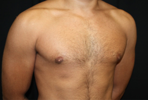 Gynecomastia Before & After Patient #21240