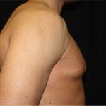 Gynecomastia Before & After Patient #21240