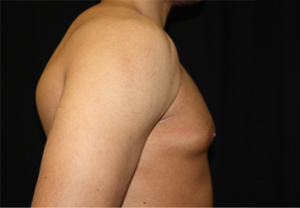 Gynecomastia Before & After Patient #21240