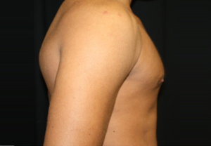 Gynecomastia Before & After Patient #21240