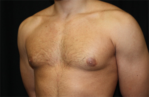 Gynecomastia Before & After Patient #21240