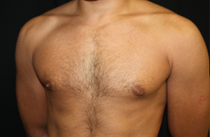 Gynecomastia Before & After Patient #21240