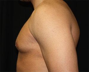 Gynecomastia Before & After Patient #21240