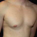 Gynecomastia Before & After Patient #23330