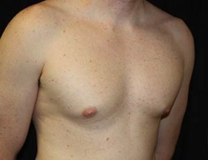 Gynecomastia Before & After Patient #23330